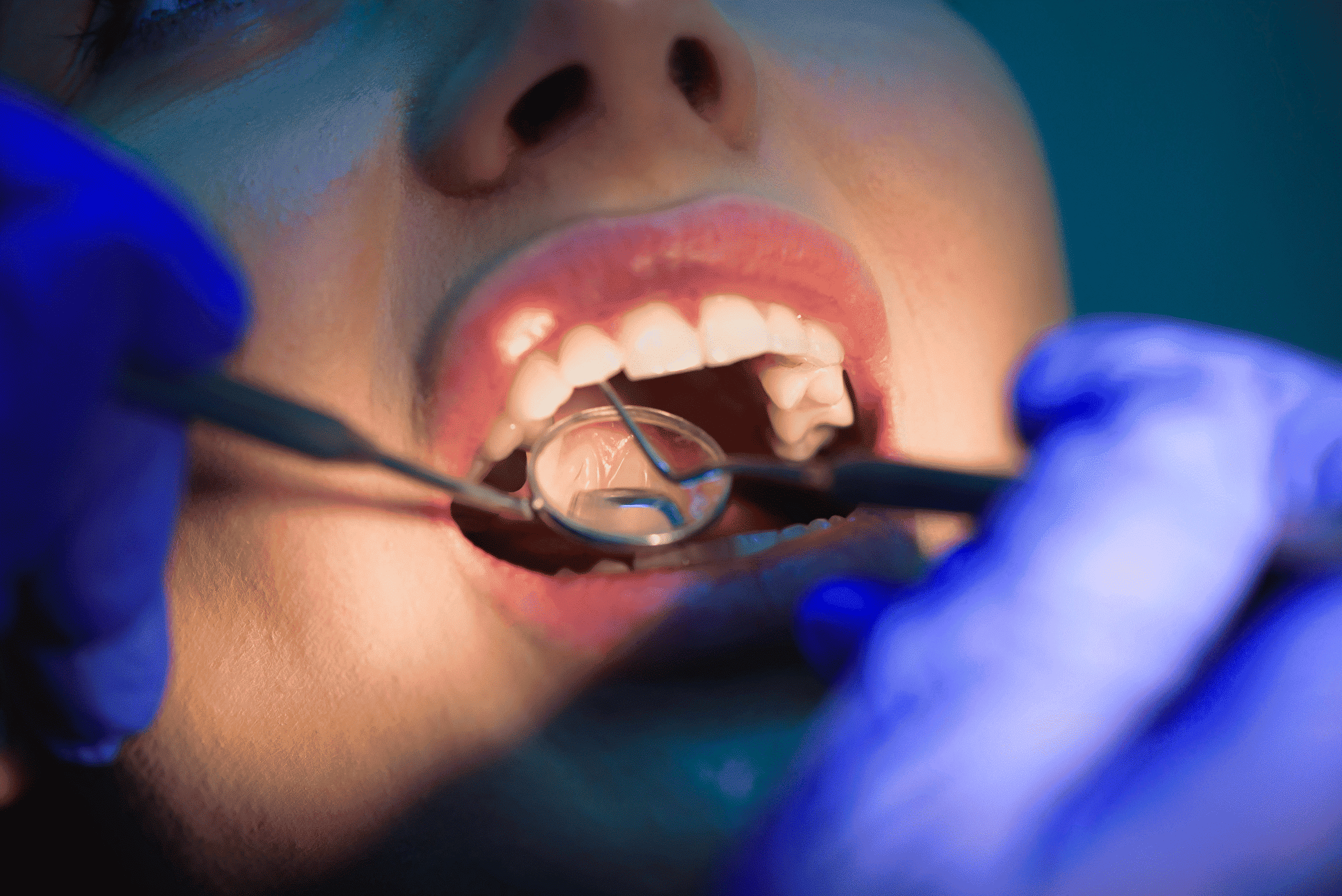 Dental-fillings