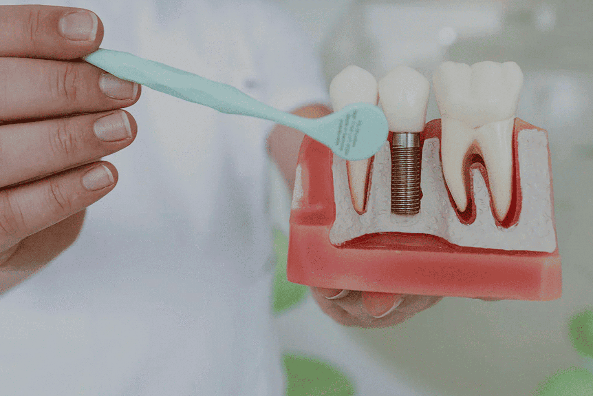 Dental-implant