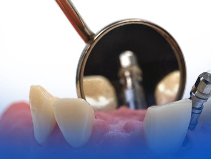 Types of fixed Dental Prostheses-Blog
